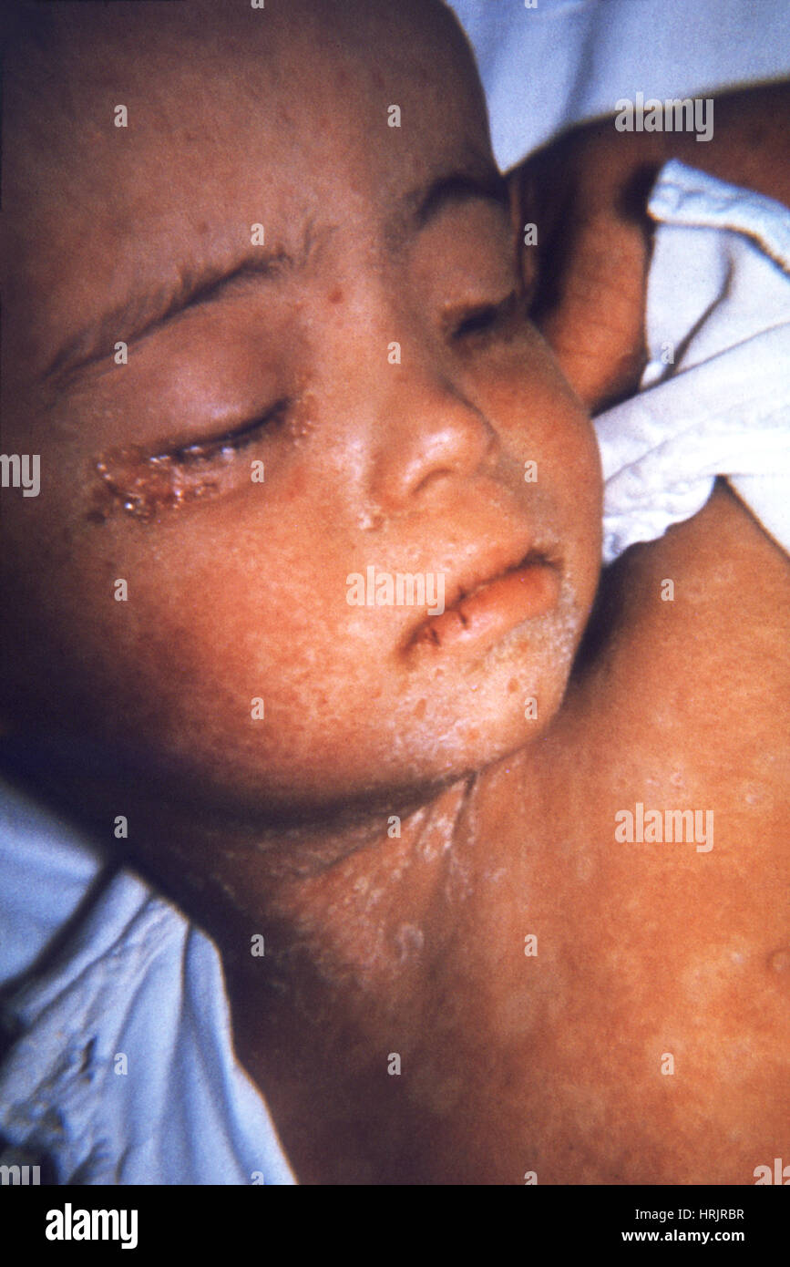 Bambino con il morbillo rash, 1968 Foto Stock
