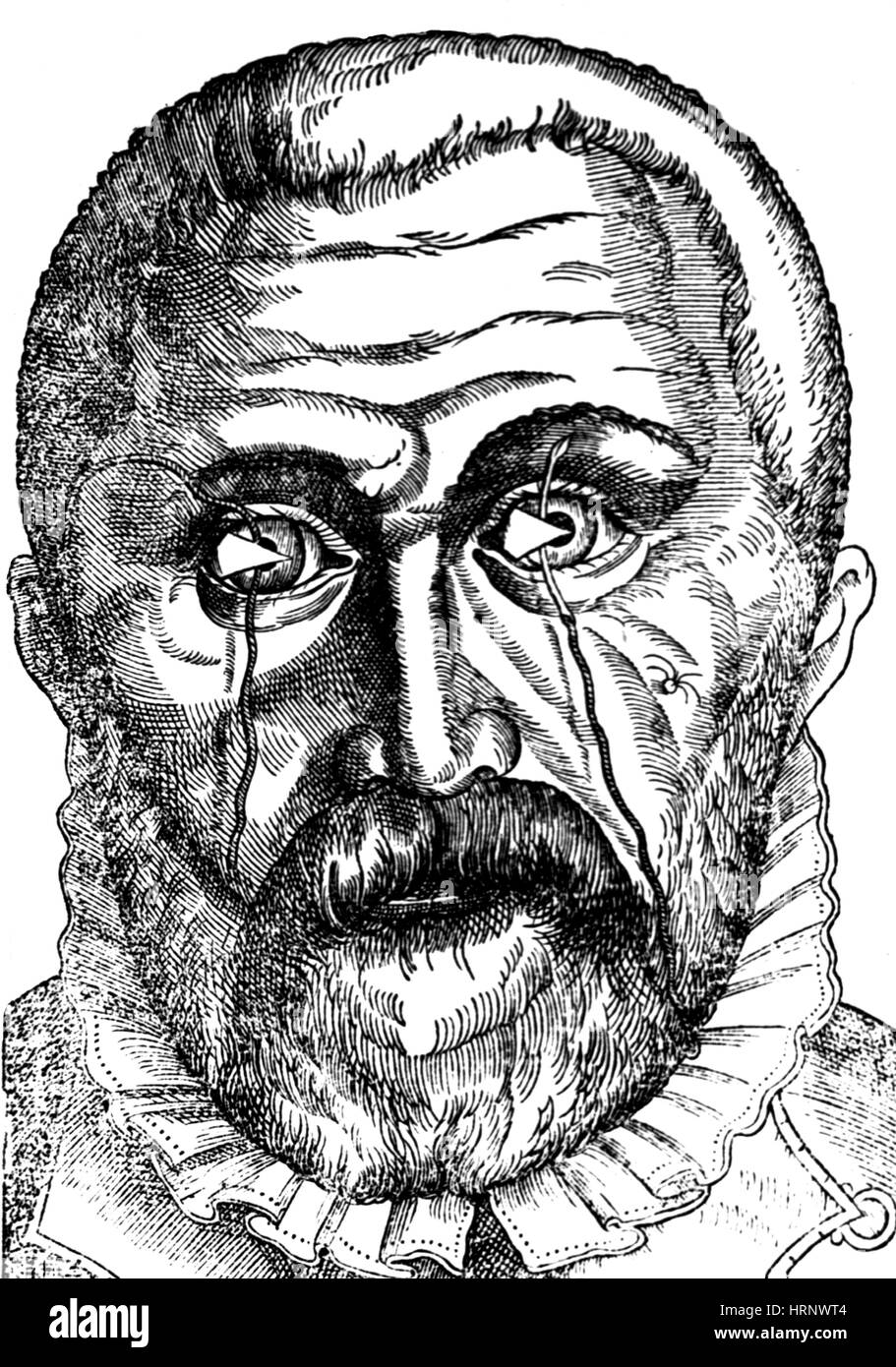 Trattamento di lo pterigio, 1583 Foto Stock