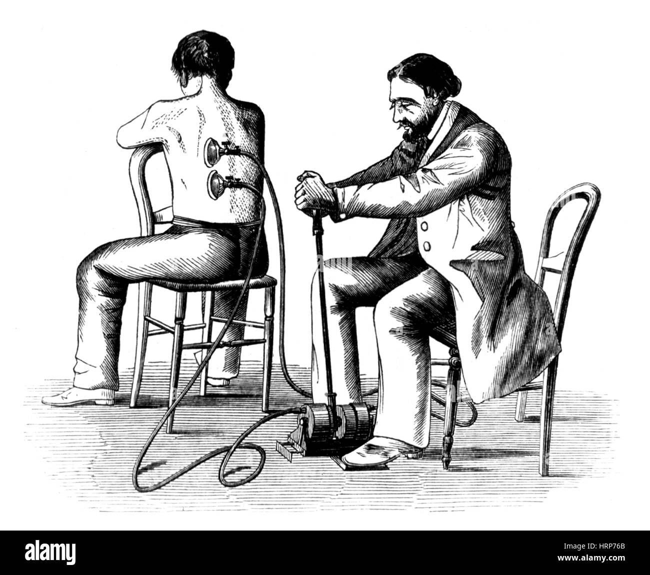 Terapia cupping, 1862 Foto Stock