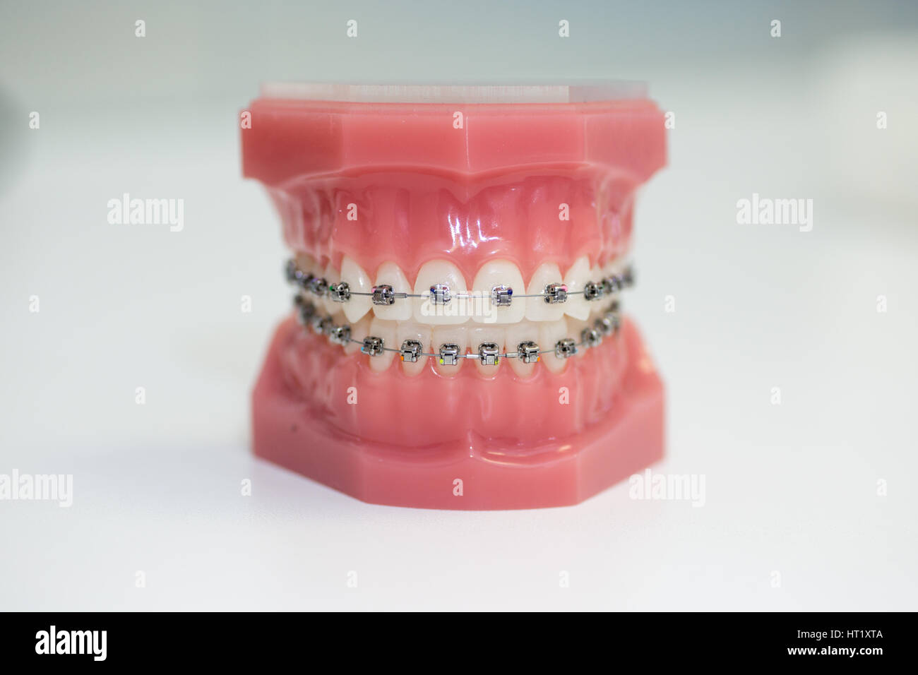 Close up dentale modello in plastica con rinforzi in metallo. modello ortodontico. Foto Stock