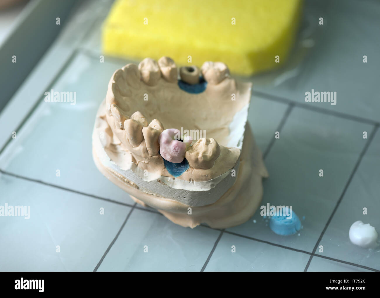 Protesi dentale, dente artificiale di protesi, mani lavorando sulla dentiera, denti finti. Foto Stock