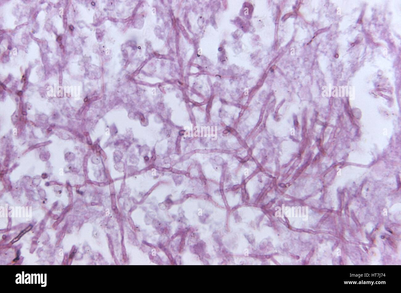 Variazioni istopatologiche in un caso di phaeohyphomycosis dovuta al fungo E. pisciphilus in un pesce gatto campione tessutale, 1973. Immagine cortesia CDC/Dott. Libero Ajello. Foto Stock