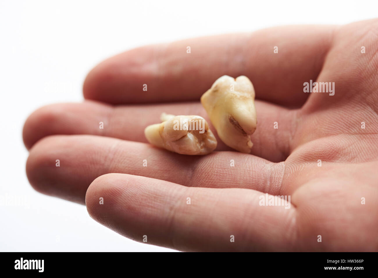 Primo piano di due denti giaceva sul palmo della mano. Macro di vecchi denti Foto Stock