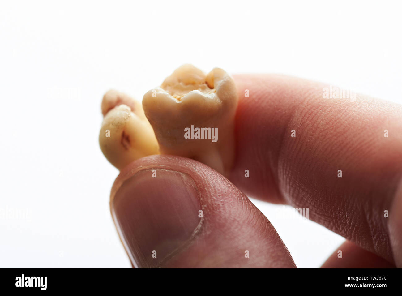 Macro di due denti in mano isolati su sfondo bianco. Primo piano della vecchia dente Foto Stock