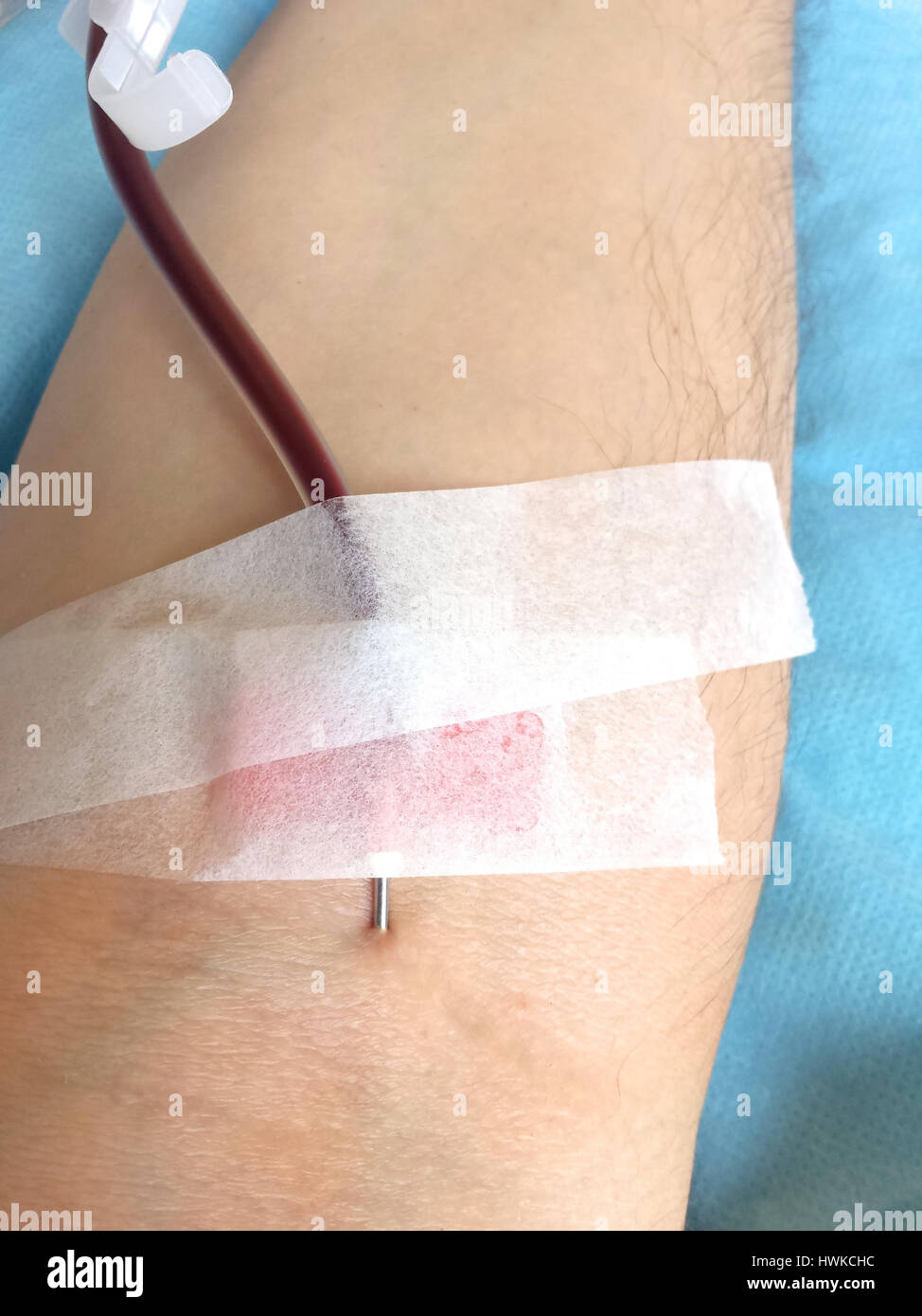 Braccio del paziente in un ospedale durante la trasfusione di sangue con l'ago all'interno del braccio Foto Stock