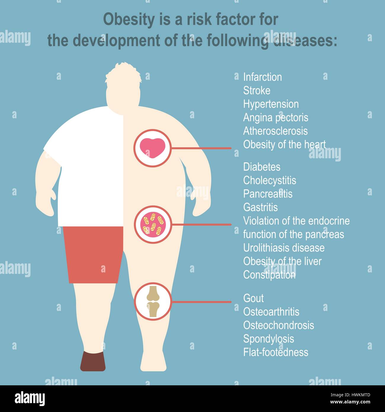 Obesità illustrazione vettoriale modello Poster l'effetto dell'obesità sulla salute umana e degli organi interni Medical poster in design piatto Illustrazione Vettoriale