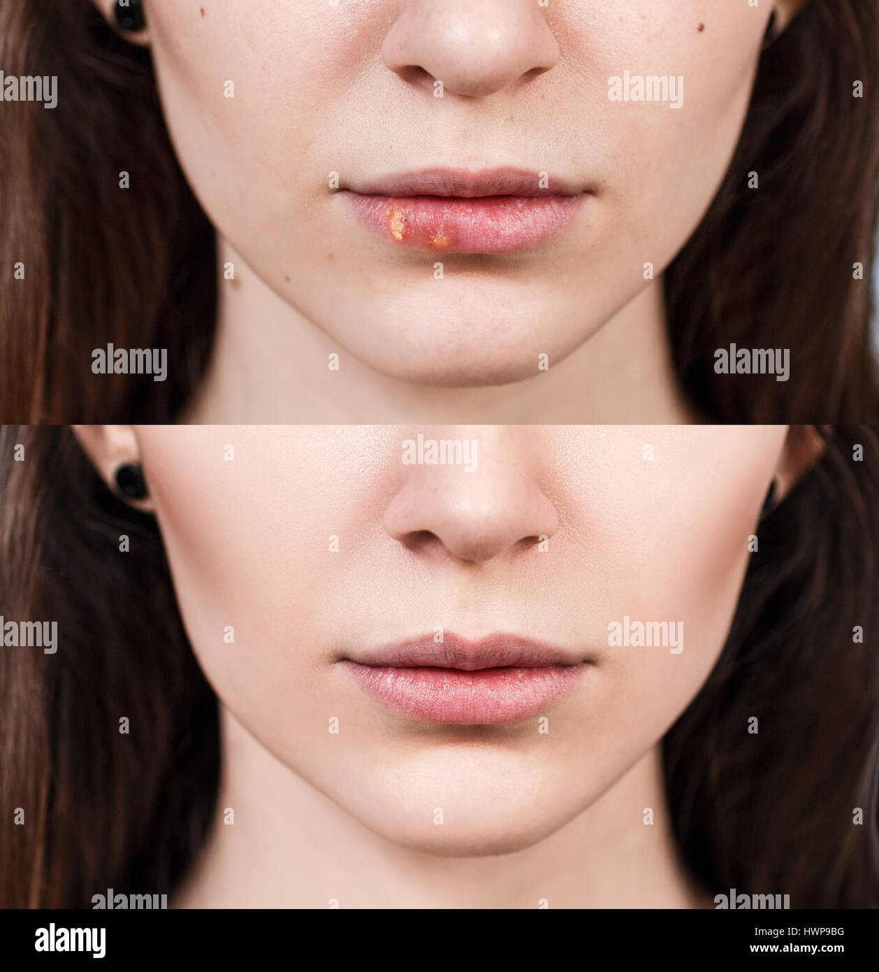 Mal di sulle labbra femminile prima e dopo il trattamento. Foto Stock