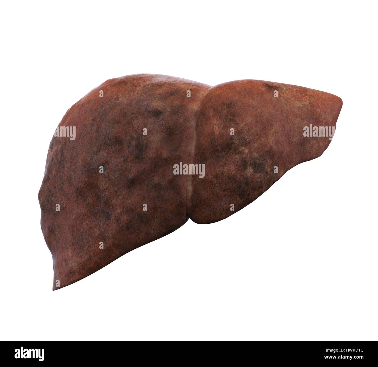 Malsana anatomia del fegato Foto Stock