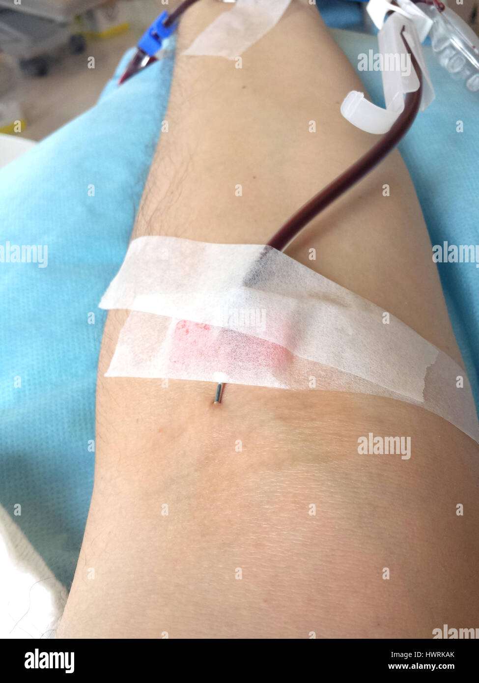 Braccio del paziente in un ospedale durante la trasfusione di sangue con l'ago all'interno del braccio Foto Stock