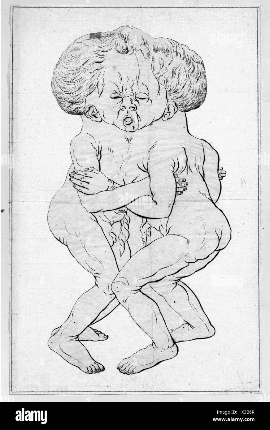 Disegno di gemelli congiunti alla testa e al torace, 10. La cortesia Libreria Nazionale di Medicina Foto stock - Alamy