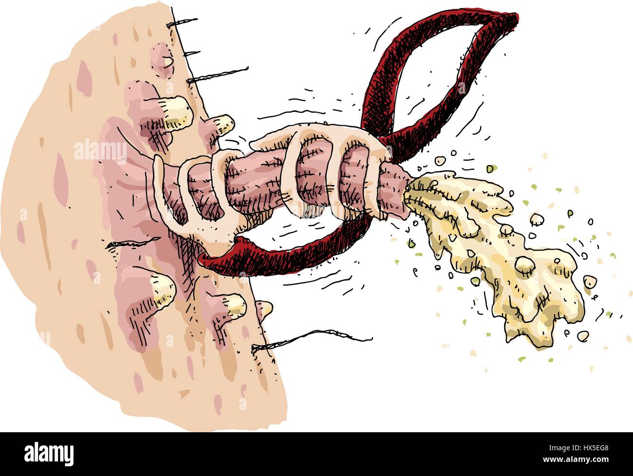 Una coppia di mani cartoon squeeze e pop un enorme brufolo sul zit coperti di pelle causando pus di emergere. Illustrazione Vettoriale