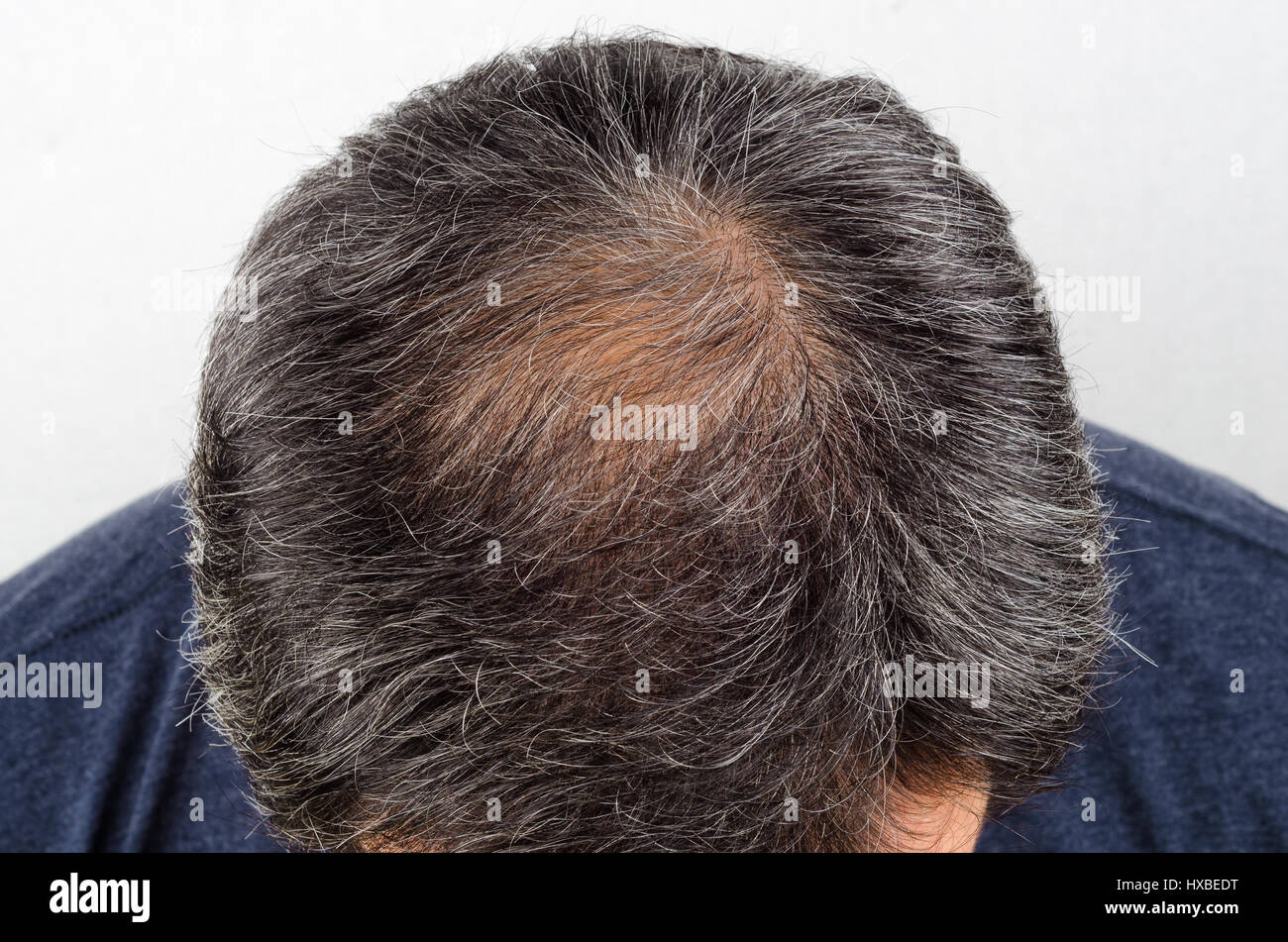 La perdita di capelli e capelli grigi, testa maschio con la perdita dei capelli i sintomi Foto Stock