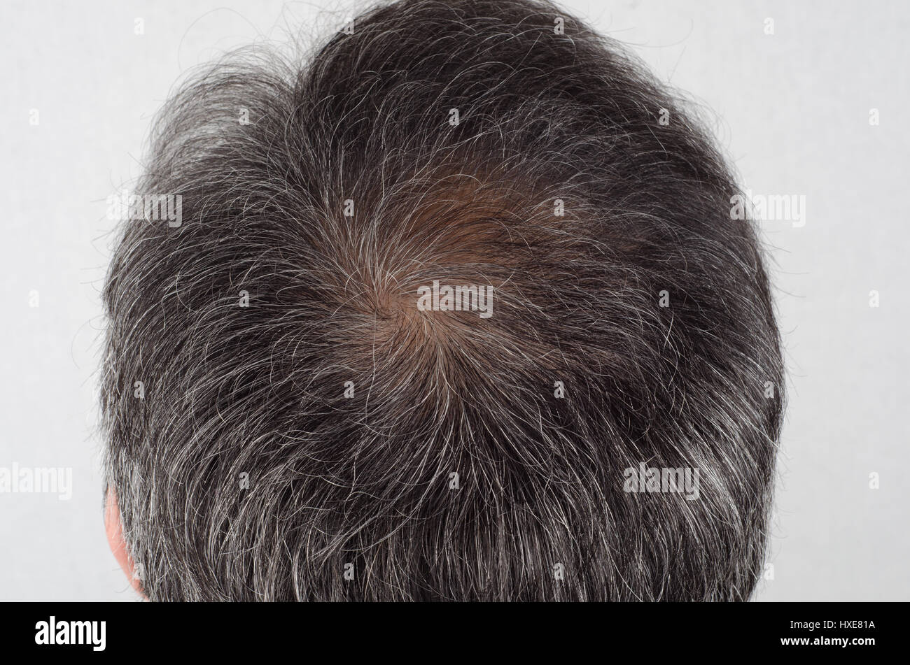 La perdita di capelli e capelli grigi, testa maschio con la perdita dei capelli i sintomi Foto Stock