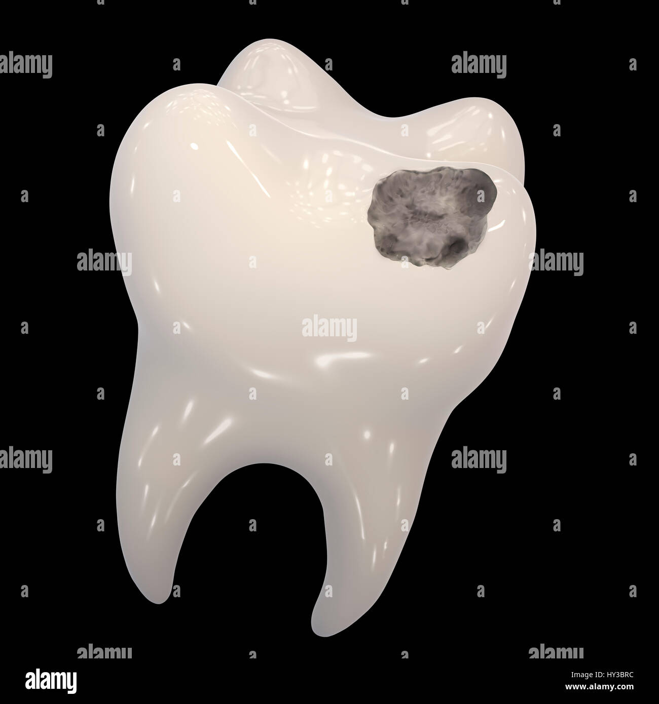 La carie dentaria. Computer illustrazione di un dente con una cavità. Foto Stock