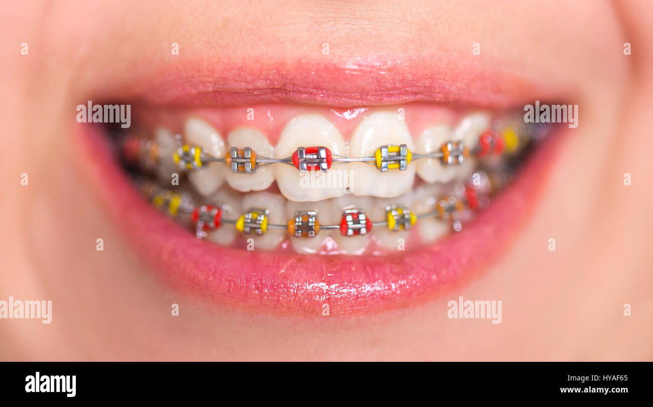 Multi-colore di staffaggio. Concetto dentale. close-up shot Foto Stock
