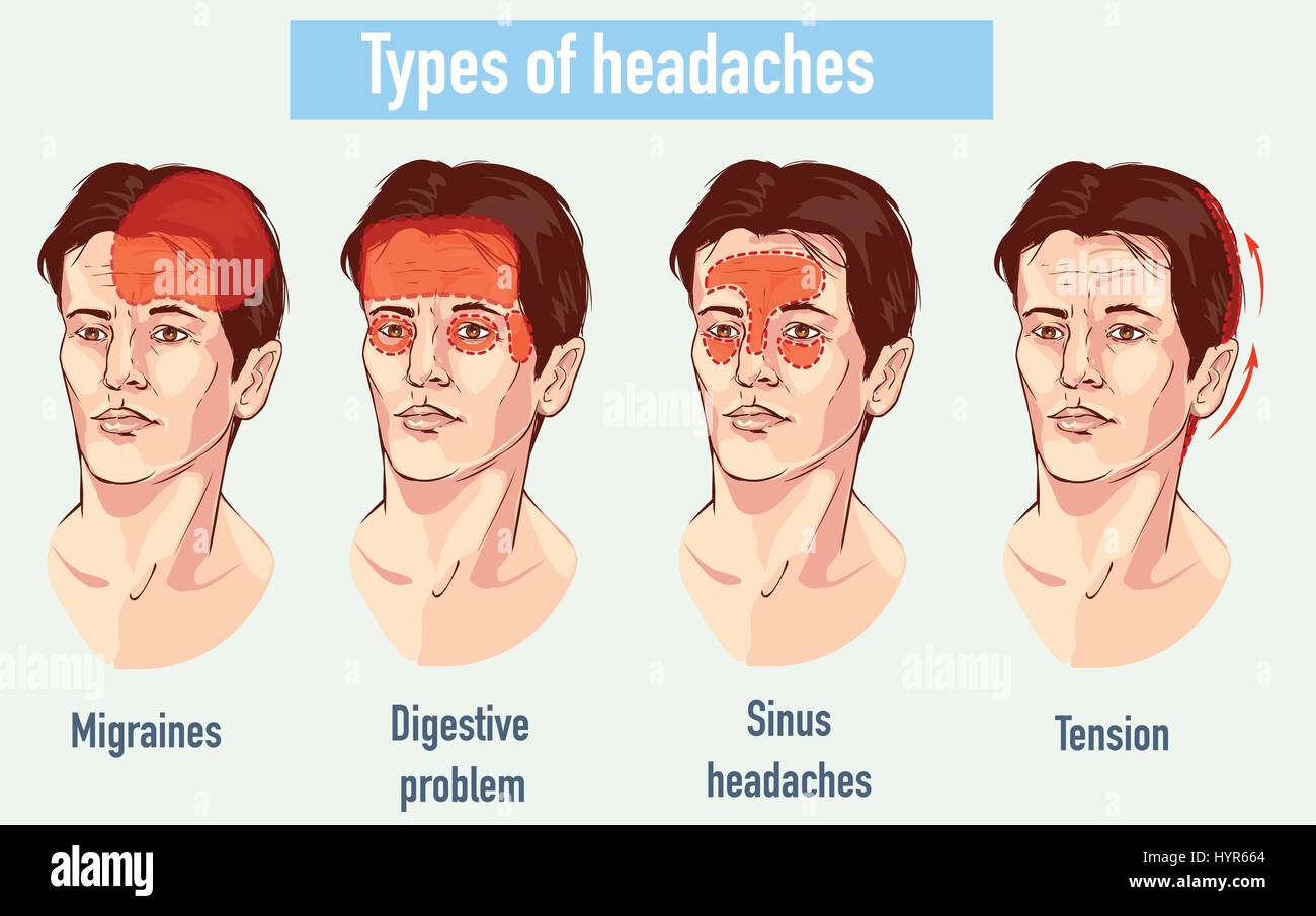 Illustrazione circa il mal di testa 4 tipo su area diversa della testa del paziente. Illustrazione Vettoriale