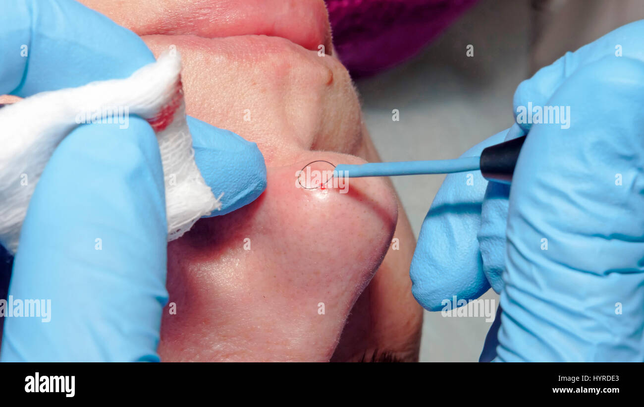 La microchirurgia: elettrocoagulazione di tumore benigno nel naso Foto Stock