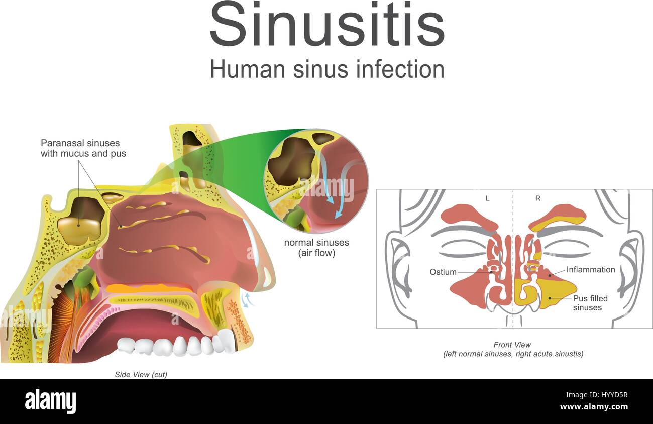 I sintomi comuni includono spesso il muco nasale, un naso ostruito, e dolore in faccia.illustrazione, arte vettoriale. Illustrazione Vettoriale