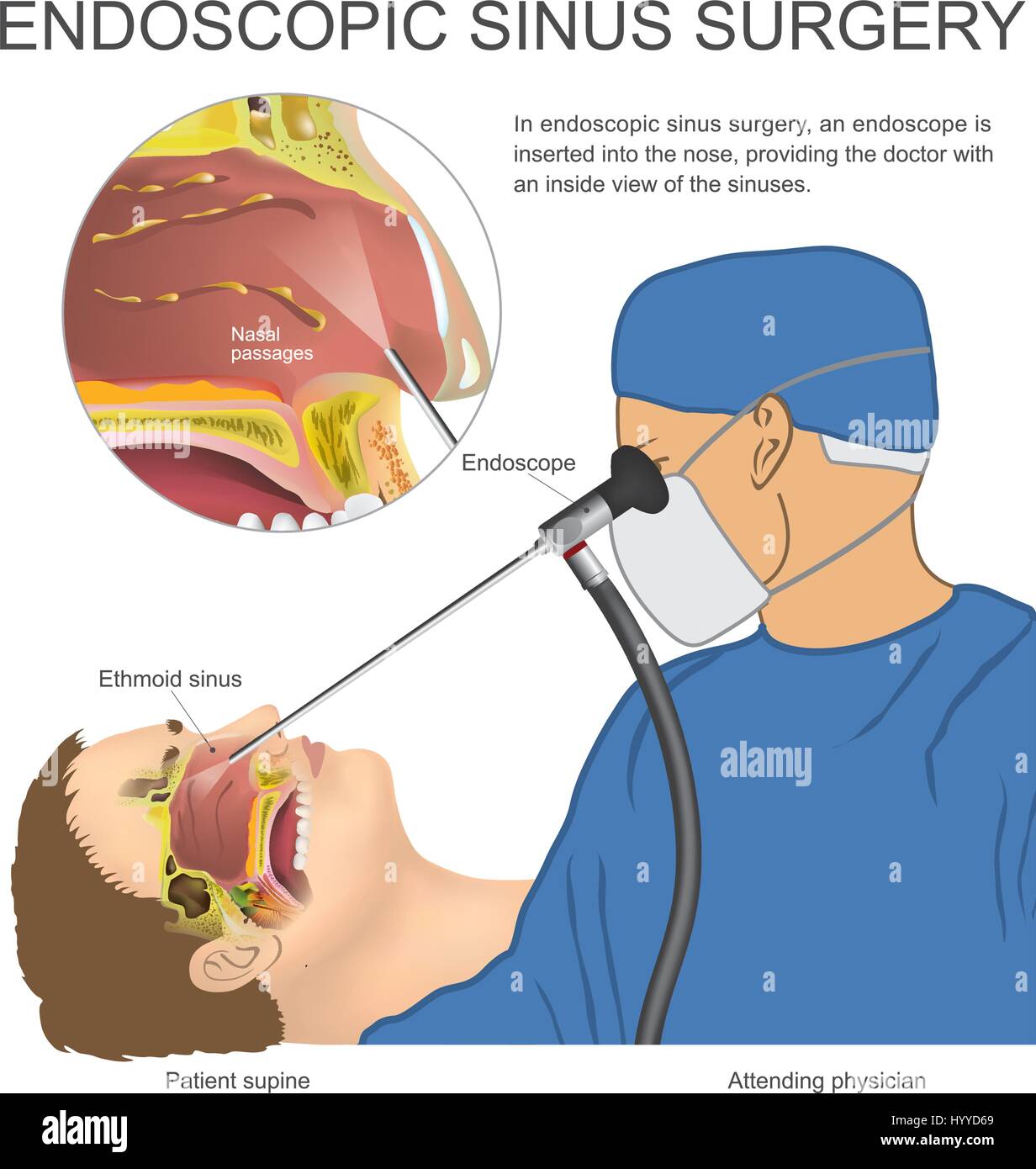 In endoscopia chirurgia sinusale, è inserito un endoscopio nel naso, fornendo il medico con una vista interna dei seni. Vettore, illustrazione. Illustrazione Vettoriale