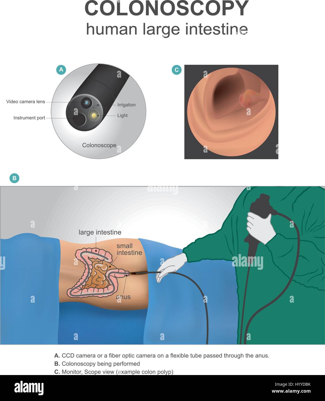 La colonscopia è un test che permette al medico di guardare la fodera interna del vostro intestino crasso. Anatomia umana illustrazione, arte vettoriale. Illustrazione Vettoriale