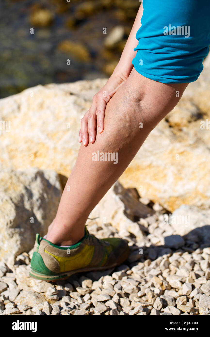 Donna toccando dolorose vene varicose su una gamba Foto Stock