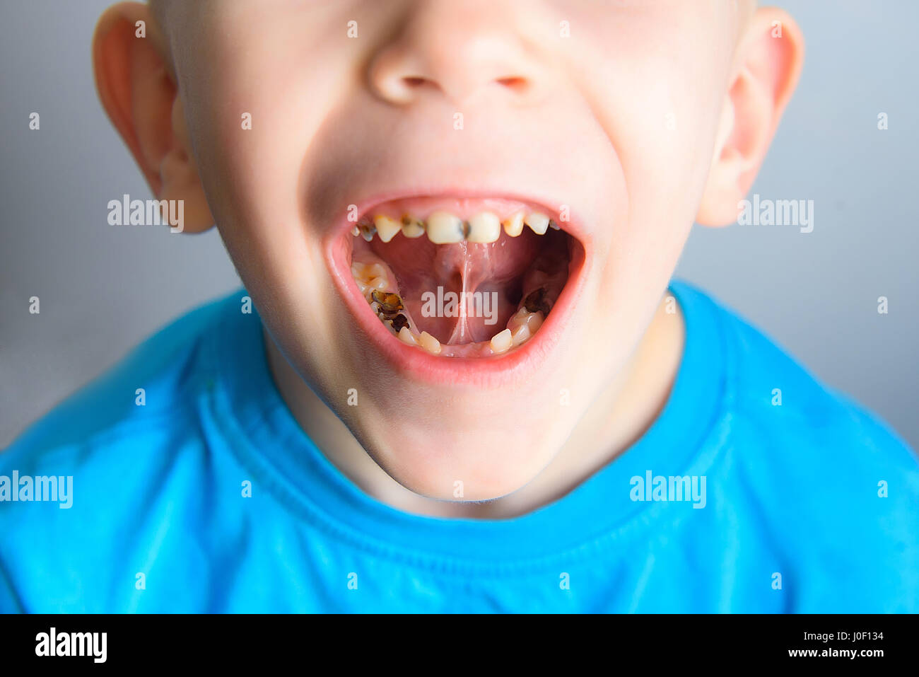 Bambino con un dente cariato immagini e fotografie stock ad alta  risoluzione - Alamy