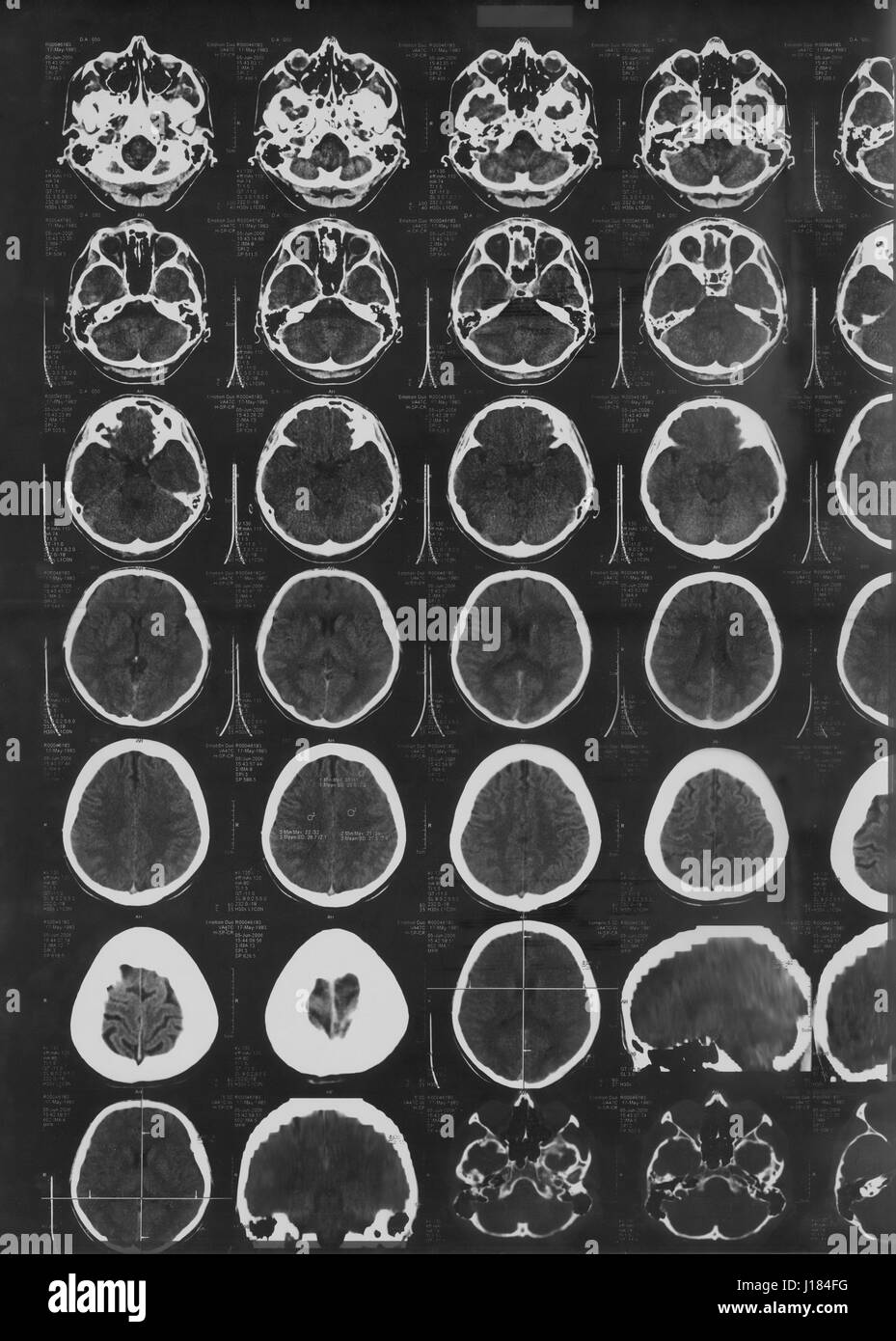 Immagine a raggi X del cervello tomografia computerizzata Foto Stock