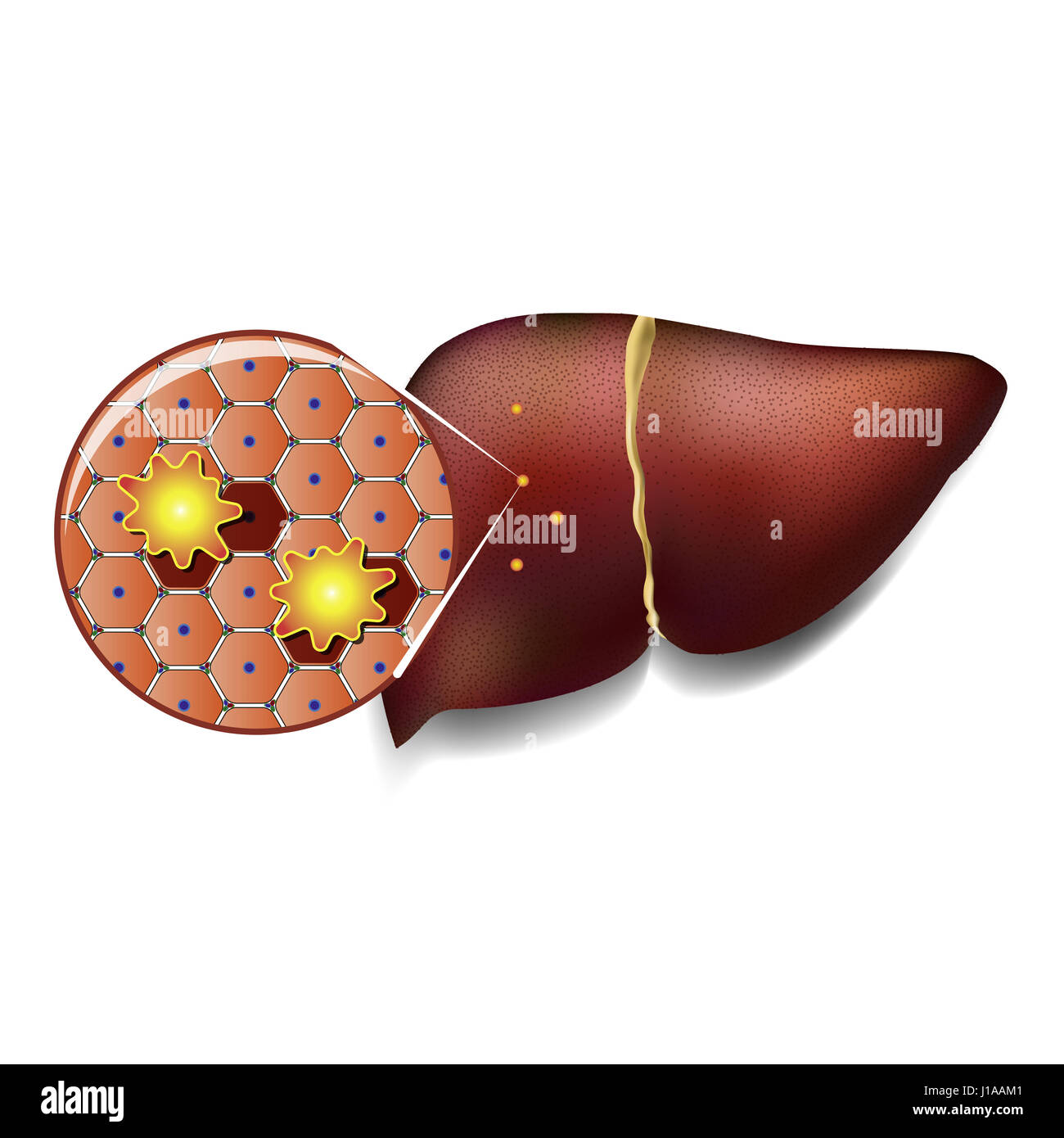 Illustrazione medica di cellule sane del fegato attaccato da tossine Foto Stock