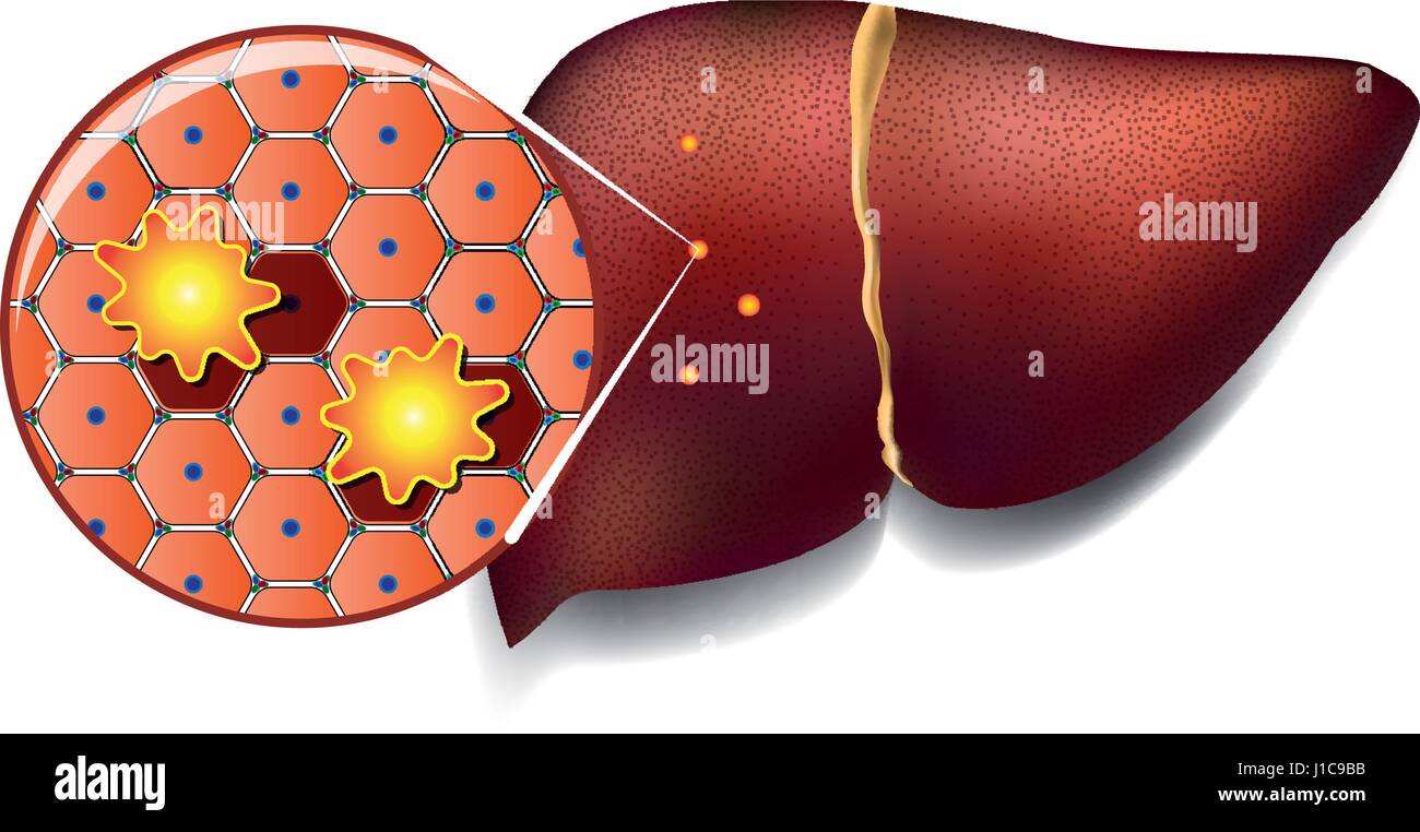 Illustrazione medica di cellule sane del fegato attaccato da tossine Illustrazione Vettoriale