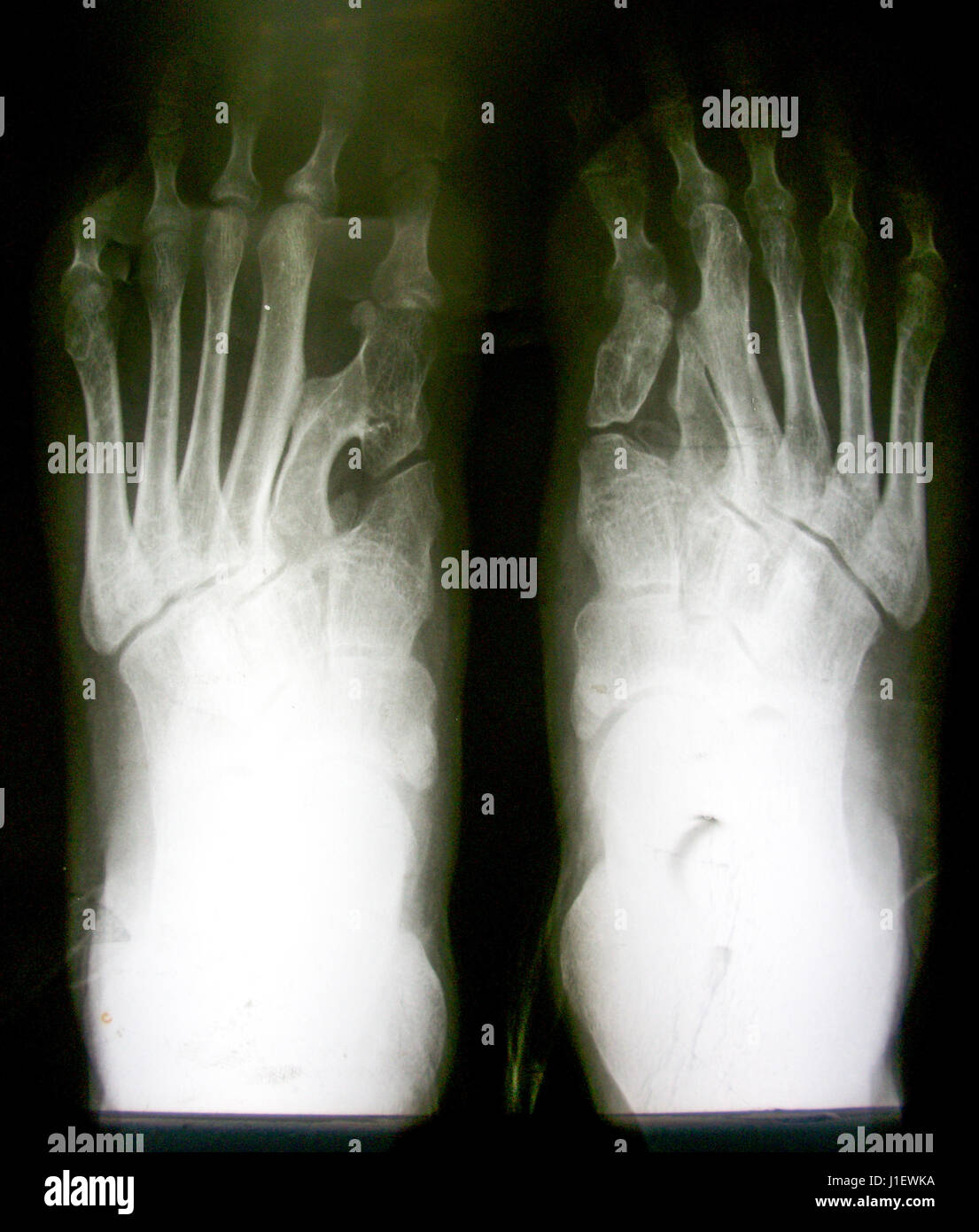 Immagine a raggi X del piede normale su entrambi i lati Foto Stock