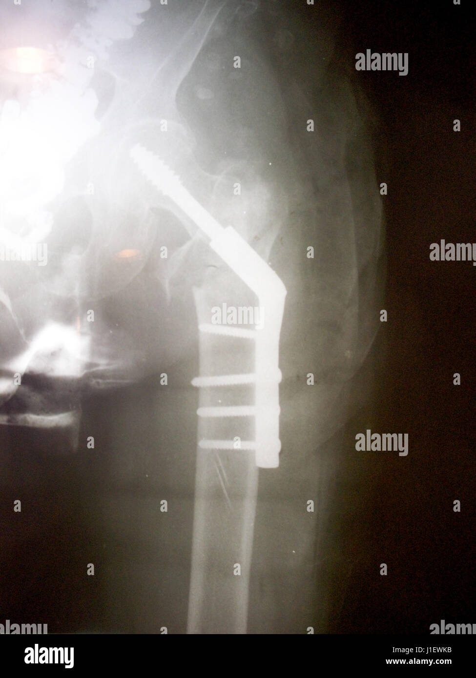 Immagine a raggi X del lato destro, anca umana la frattura del collo del femore osso. Riduzione aperta per la fissazione interna con osso interno asta a vite e da sovracorrente ortopedici Foto Stock