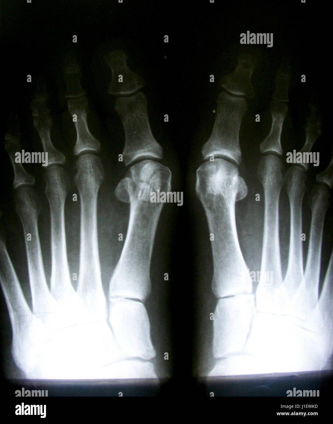 Immagine a raggi X del piede normale su entrambi i lati Foto Stock