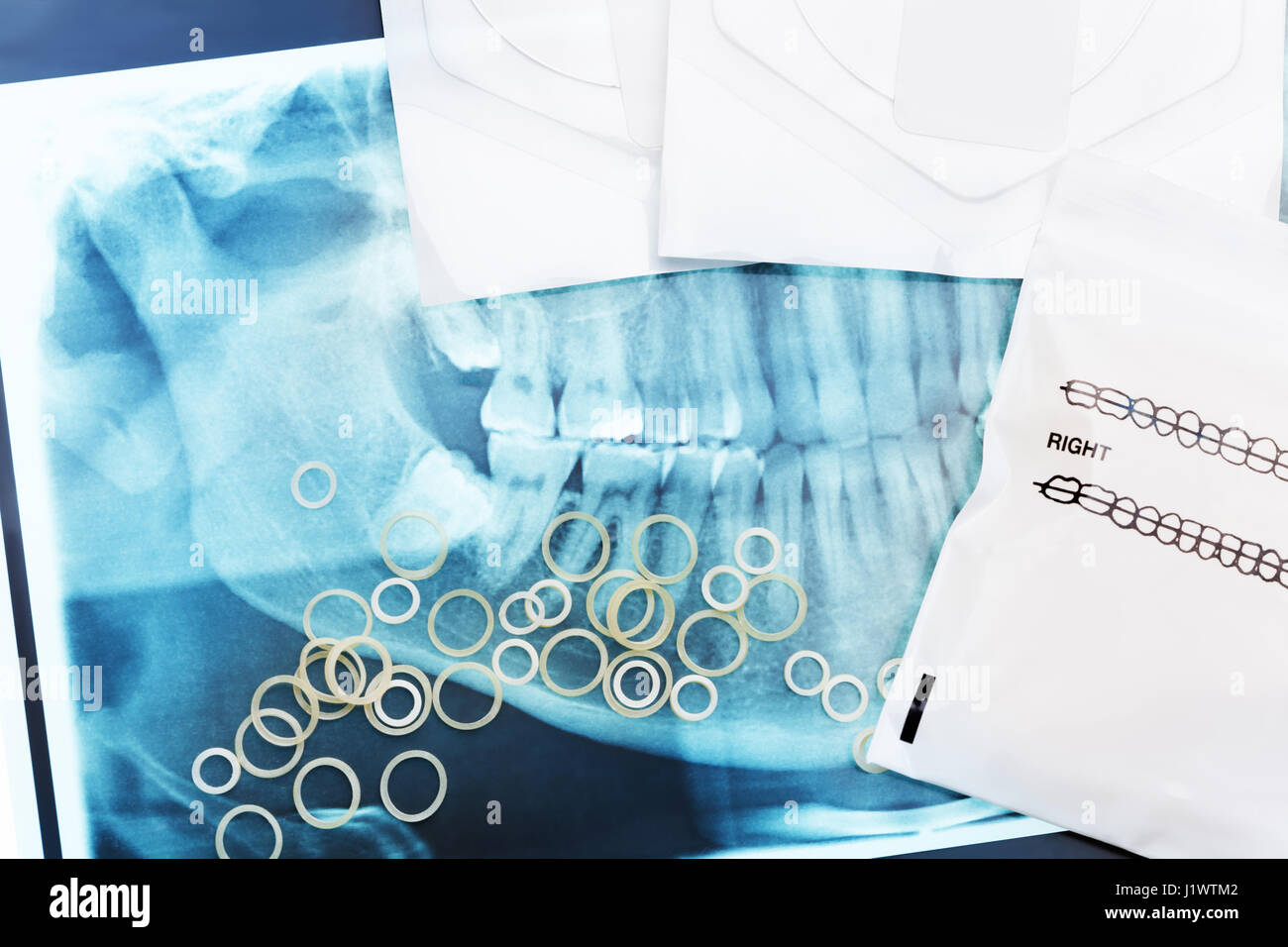 Molti dentale denti ortodontico bretelle in lattice di gomma anelli sui raggi x delle ganasce Foto Stock
