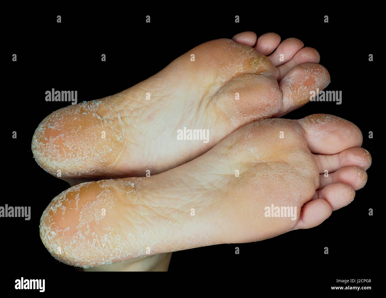 Peeling della pelle fuori da entrambi i piedi a fianco a fianco, sulla  persona adulta Foto stock - Alamy