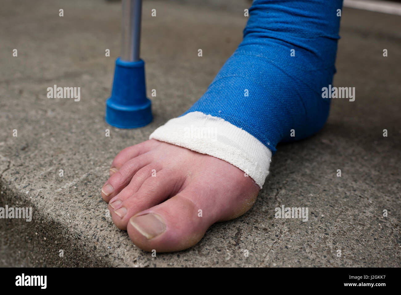 Dettaglio del piede bendato in gesso in pietra porta al di fuori di un appartamento. A piedi nudi le dita dei piedi sono fuori di fasciatura. Foto Stock