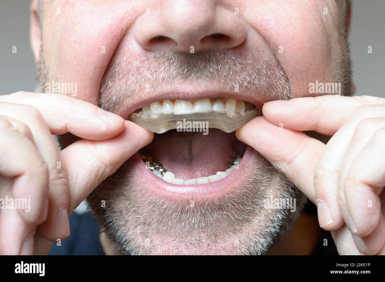 L'uomo ponendo una piastra di morso in bocca per proteggere i suoi denti di notte dalla macinazione causato da Bruxismo, Vista ravvicinata della mano e l'apparecchio Foto Stock