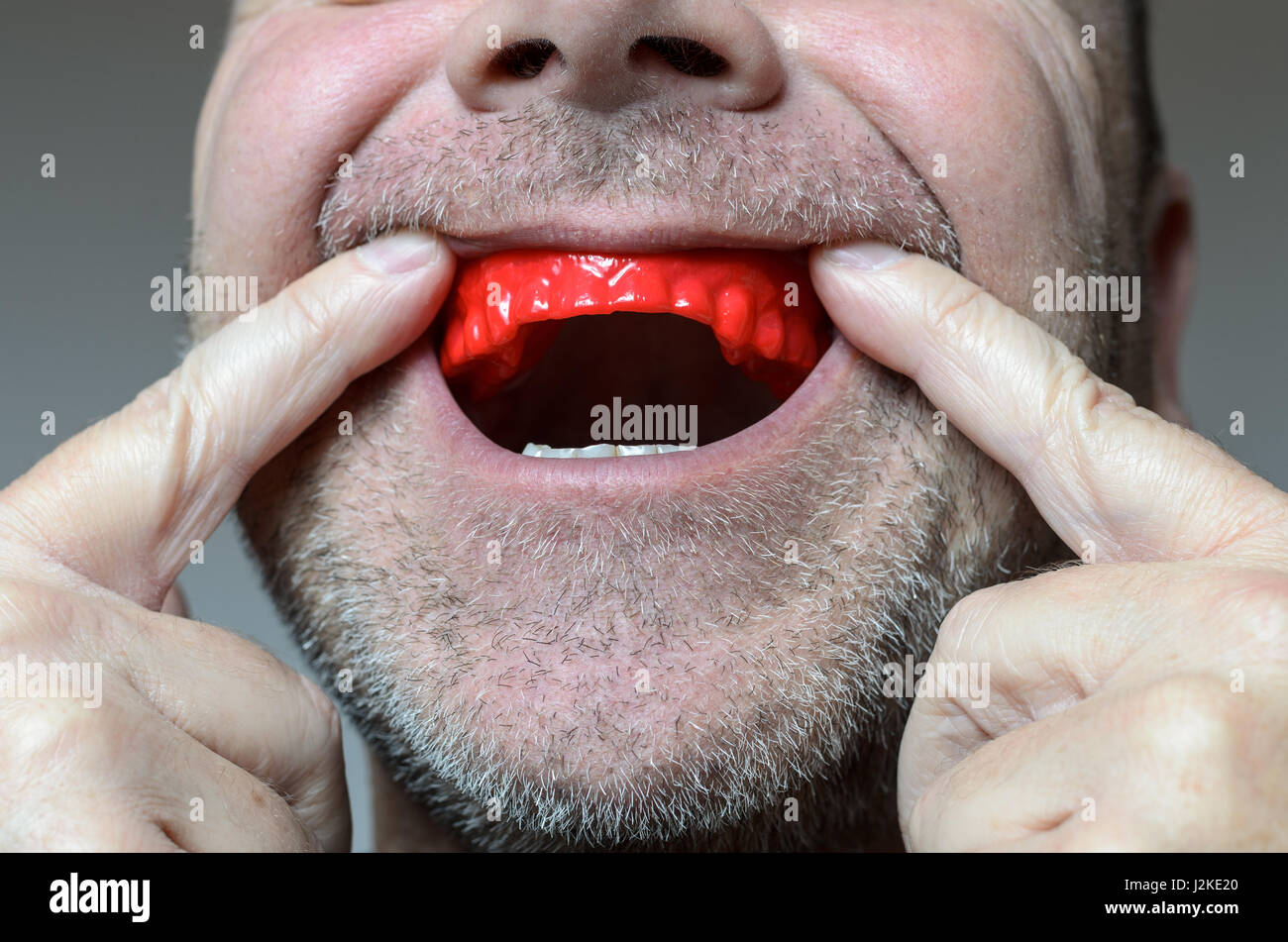L'uomo collocando un morso rossa piastra nella sua bocca per proteggere i suoi denti di notte dalla macinazione causato da Bruxismo, Vista ravvicinata della mano e l'apparecchio Foto Stock
