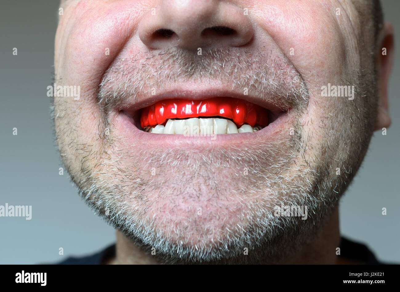 Uomo di mordere su una rossa piastra morso in bocca per proteggere i suoi denti di notte dalla macinazione causato da Bruxismo, Vista ravvicinata della mano e l'apparecchio Foto Stock