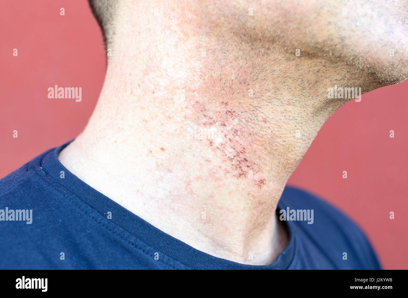 Irritazione della pelle dopo la chirurgia cosmetica vicino sul collo di Le  Mans Foto stock - Alamy