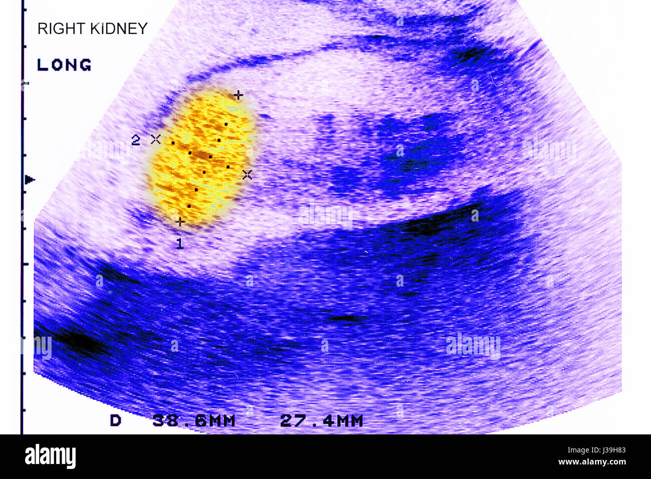 Il cancro del rene, ecografia Foto Stock