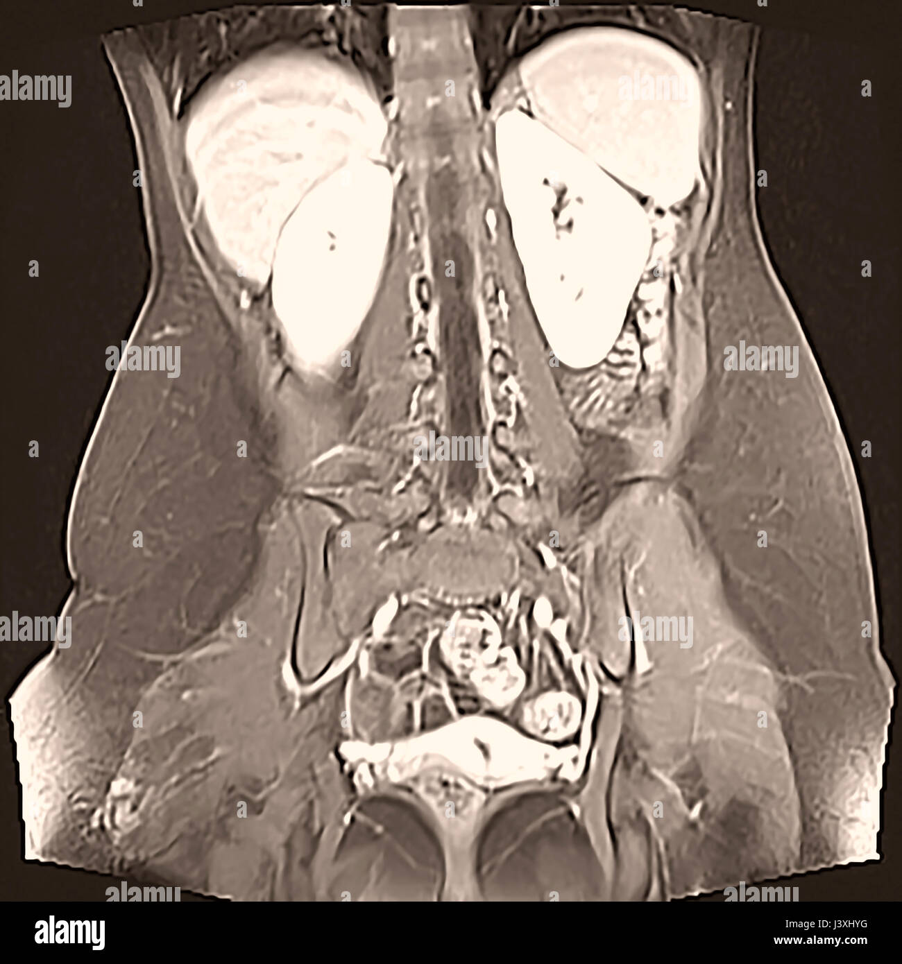 Enterography chiamato anche un studio gastrointestinale o contrasto radiografia del tratto gastrointestinale, è una serie di radiografie utilizzato per esaminare il t Foto Stock