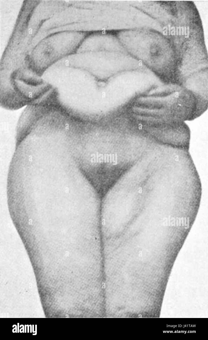 La frase "la mÃªme que PrÃ©CÃ©demment paroi soulevÃ©e" si riferisce a un'opera d'arte o a una raffigurazione che mostra un muro rialzato, che è un concetto o un design spesso esplorato in campo architettonico e artistico. Foto Stock