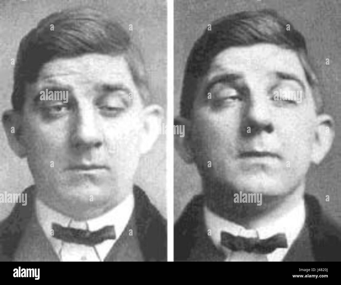 Miastenia Gravis è una malattia neuromuscolare autoimmune caratterizzata da debolezza muscolare volontaria. La condizione si verifica quando il sistema immunitario del bodyÂ attacca la giunzione neuromuscolare, portando alla stanchezza muscolare e alla debolezza. Foto Stock