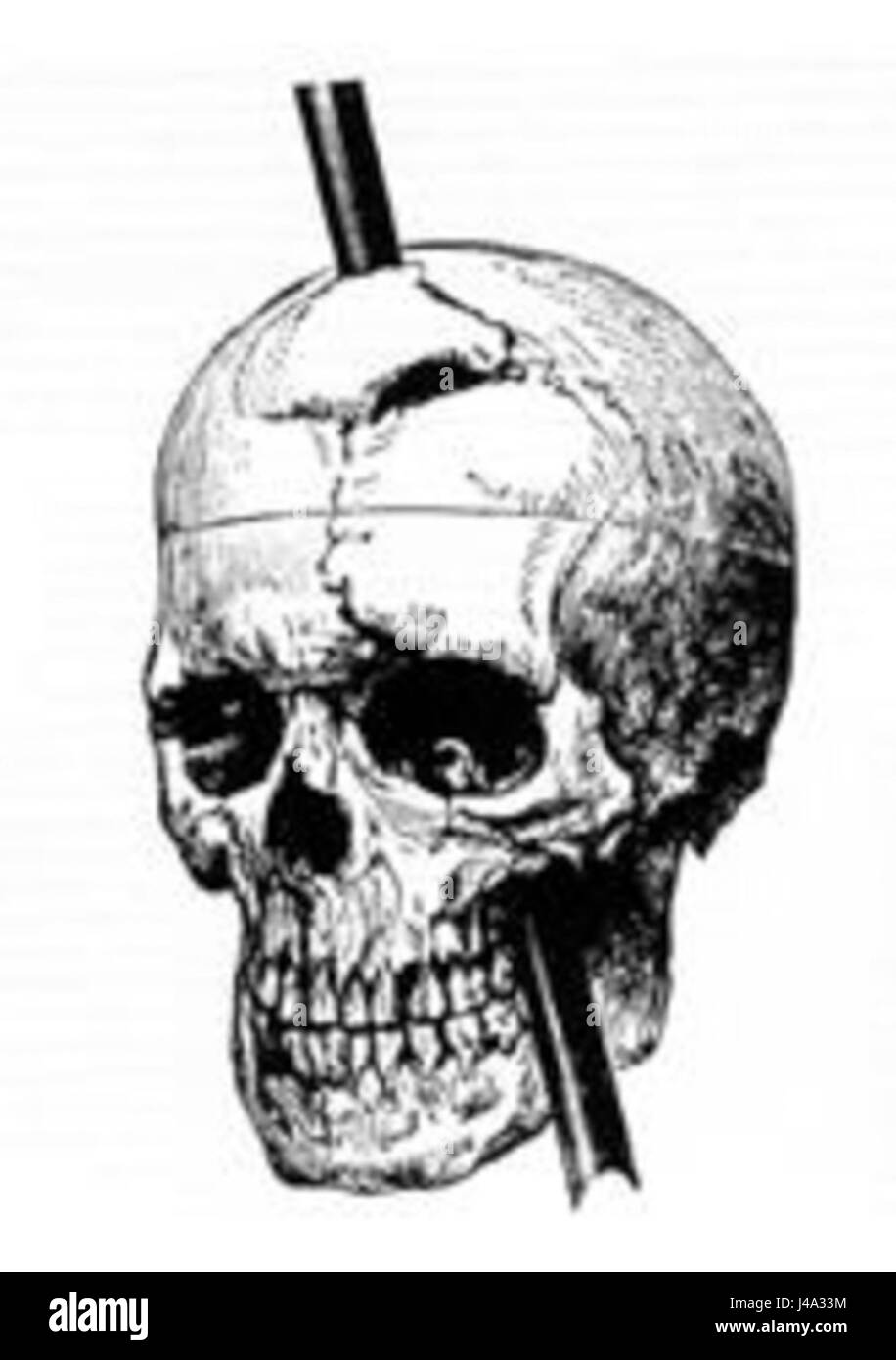 Il diagramma del cranio di Phineas Gage, creato nel 1868, mostra il percorso dell'asta di ferro che gli perforò il cranio in un incidente traumatico nel 1848. Gage sopravvisse alla lesione, ma ebbe significativi cambiamenti di personalità, fornendo una prova precoce del ruolo del lobo frontale nel comportamento e nella cognizione. Foto Stock