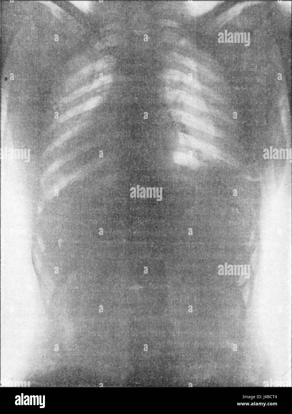 La radiografia, 'Radiographie du thorax de la fig28', fornisce un'immagine radiografica del torace umano, mostrando le strutture interne del torace, che è vitale per le diagnosi mediche e la comprensione dell'anatomia umana. Foto Stock