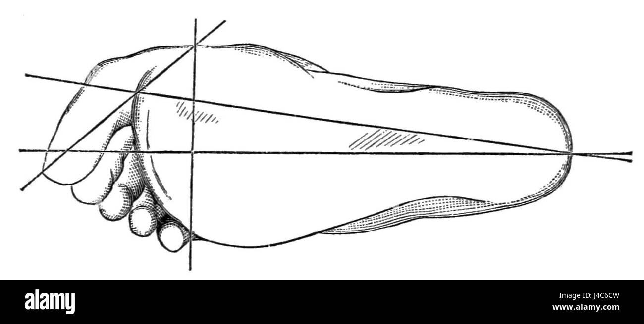 Questa immagine del PSM V24 D667 mostra un case study medico relativo ai crampi causati dalle scarpe. Esamina gli effetti di calzature improprie sul corpo umano, offrendo una comprensione precoce della comprensione medica dei problemi di salute fisica. Foto Stock
