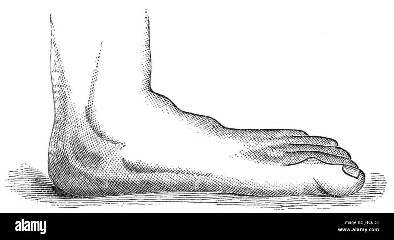 Questa illustrazione del PSM volume 24, D672, si concentra sulla condizione medica nota come piedi piatti o piedi sparsi. Offre una rappresentazione visiva e una descrizione della condizione, delle sue caratteristiche fisiche e del potenziale impatto sulla salute e sul movimento. Foto Stock