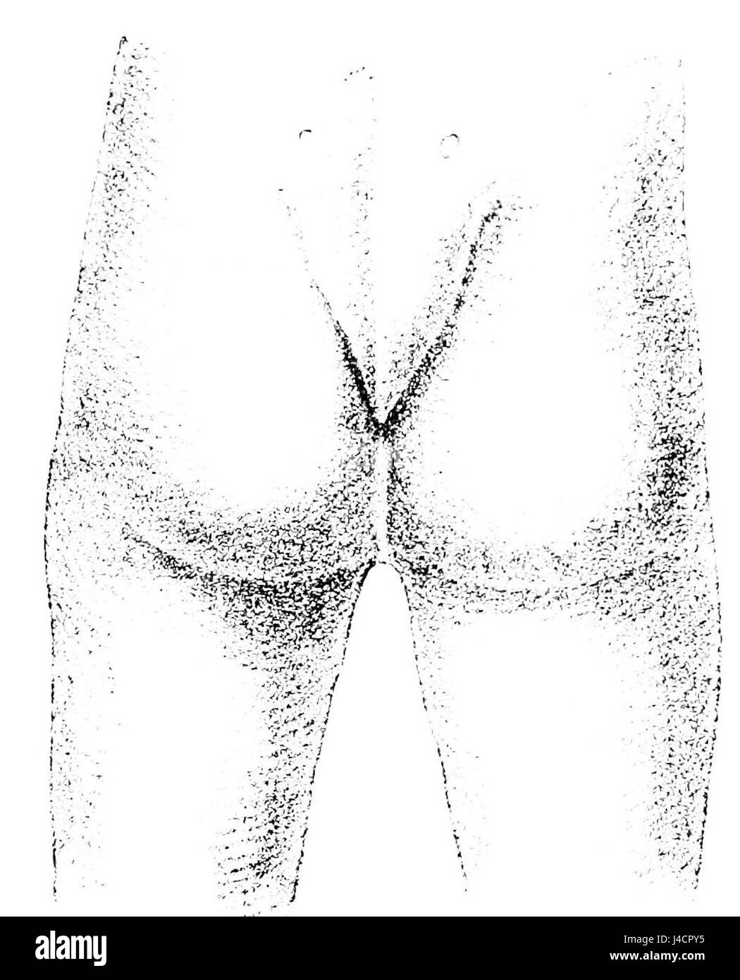 Questa immagine tratta dalla pubblicazione "PSM V40 D371" raffigura un bambino di tre giorni con una coda nascosta, che presenta una condizione medica o genetica di interesse storico. Foto Stock