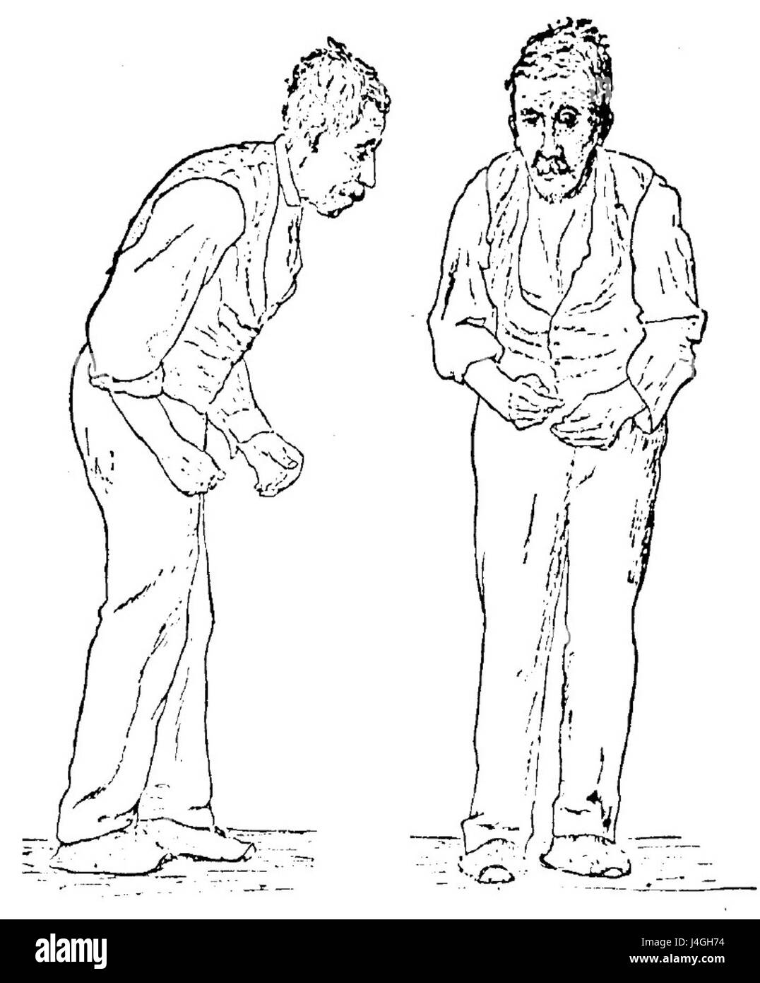 Uno schizzo del 1886 di Sir William Richard Gowers raffigurante gli aspetti clinici del morbo di Parkinson, riflettendo la prima comprensione medica della condizione. Foto Stock