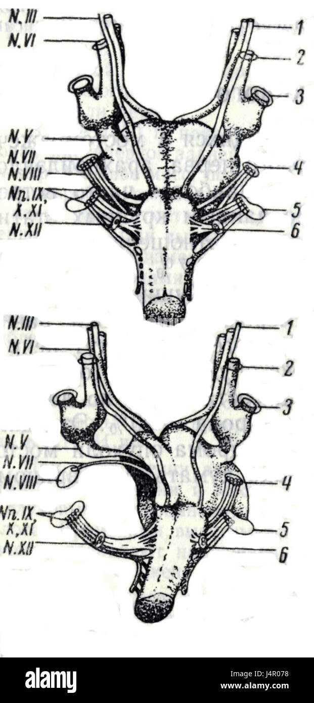 Schwannoma vestibolare topografia, lo studio delle caratteristiche spaziali e anatomiche degli schwannomi vestibolari, un tumore benigno che colpisce il nervo vestibolare, che influisce sull'equilibrio e sull'udito. Foto Stock